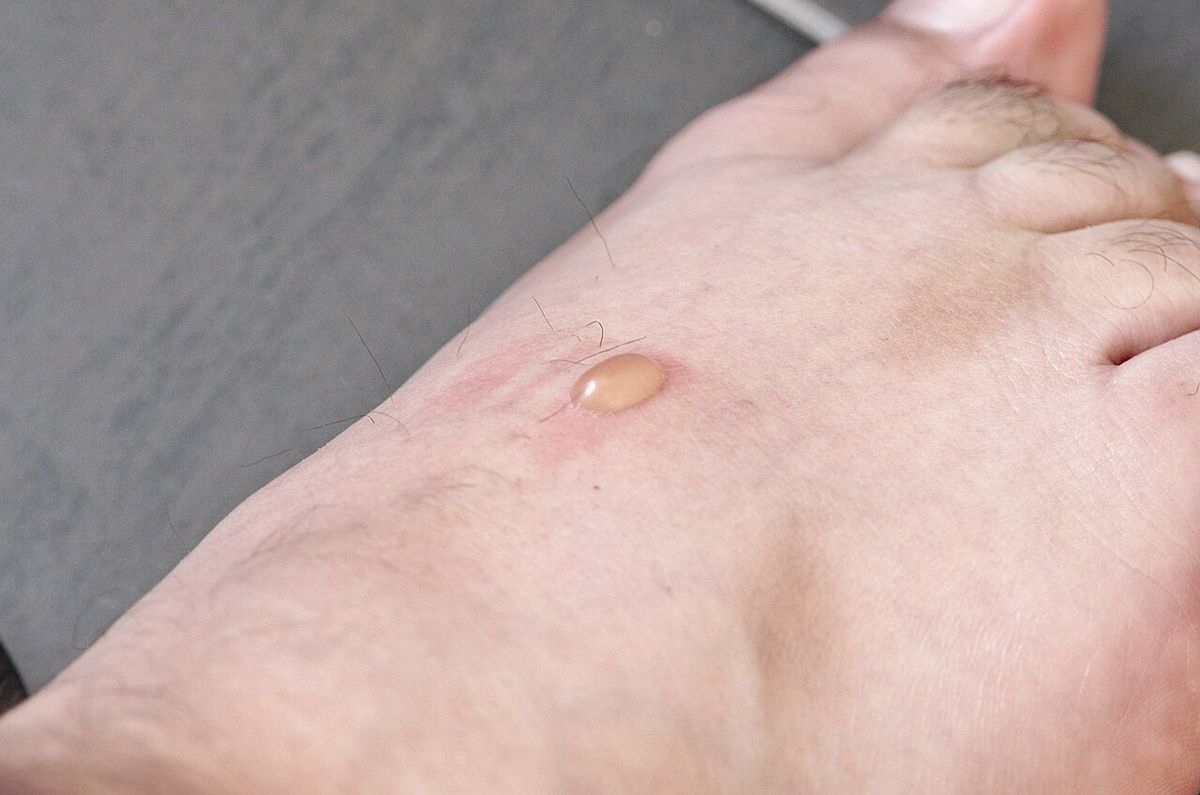 A small clear blister on the top of a foot