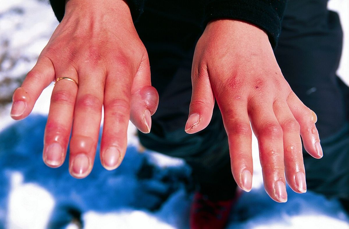 Two hands with red, swollen fingertips held over blue fabric