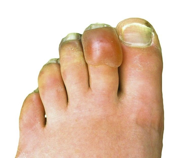 Toes darkened and blistered by frostbite